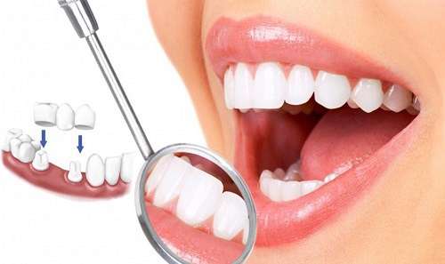 Bọc răng sứ duy trì được bao lâu thì phải làm lại? 1