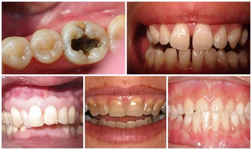 Bọc răng sứ duy trì được bao lâu thì phải làm lại? 2