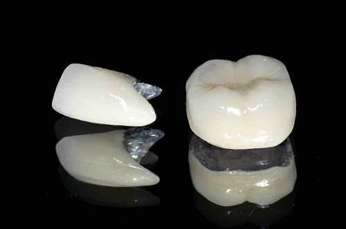 Bọc răng sứ kim loại có bền không cho răng hàm? 1