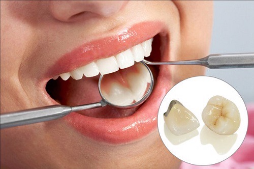 Bọc răng sứ kim loại có bền không cho răng hàm?-3