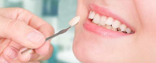 Bọc răng sứ veneer có tốt không - Khách hàng review 2