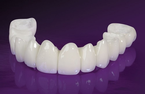 Bọc răng toàn sứ mang đến bạn nụ cười xinh tự nhiên 2