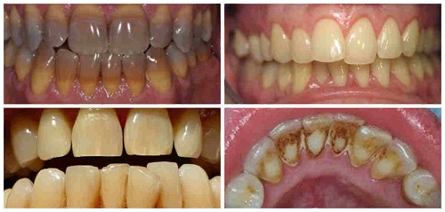 Có nên tẩy trắng răng nhiều lần không? 2