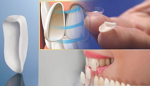 Dán răng sứ có bền không nhận định từ chuyên gia 1