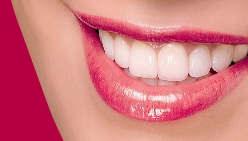 Dán răng sứ có bền không nhận định từ chuyên gia 2