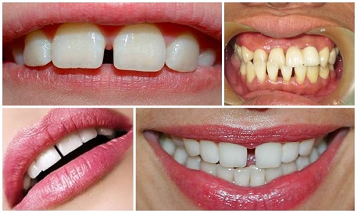 Dán sứ cho răng thưa giúp bạn tự tin với nụ cười duyên dáng 1