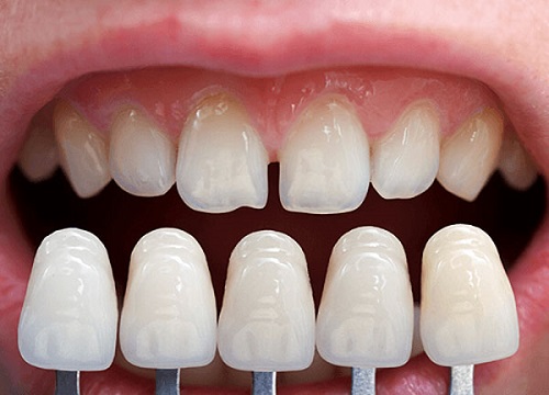 Dán sứ cho răng thưa giúp bạn tự tin với nụ cười duyên dáng 2