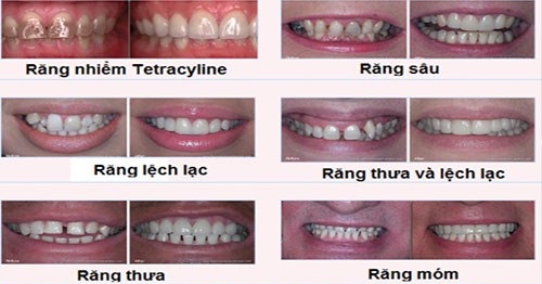 Làm răng sứ cả hàm thường được áp dụng khi nào? 1