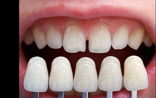 Làm răng sứ cả hàm thường được áp dụng khi nào? 2