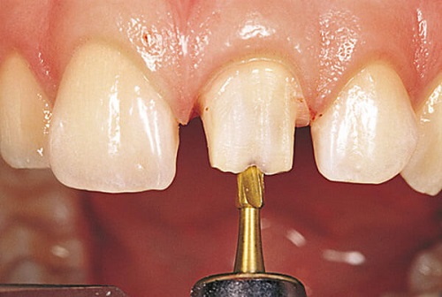 Làm răng sứ có đau không? Cần thông tin chính xác-2