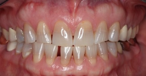 Làm răng sứ không mài răng với lớp dán sứ mỏng 3