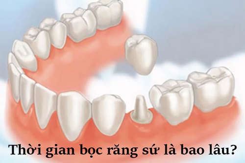 Quá trình làm răng sứ mất bao lâu là hoàn thành?-1 Quá trình làm răng sứ mất bao lâu là hoàn thành?-1