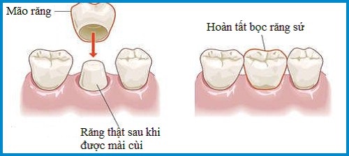 Làm răng sứ phải kiêng gì để kéo dài tuổi thọ cho răng? 2