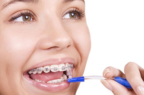 Niềng răng có nguy hiểm không? Những thông tin nên biết trước khi niềng răng-4 Niềng răng có nguy hiểm không? Những thông tin nên biết trước khi niềng răng-4