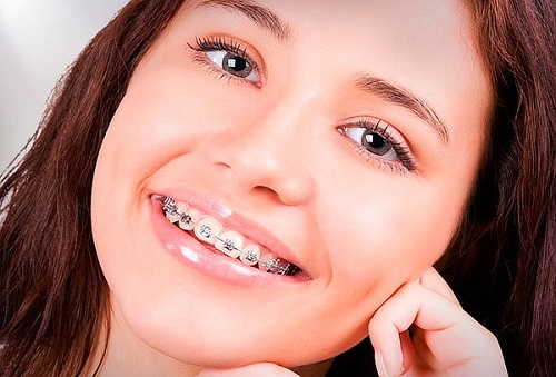 Niềng răng khểnh bao lâu là có kết quả?-3