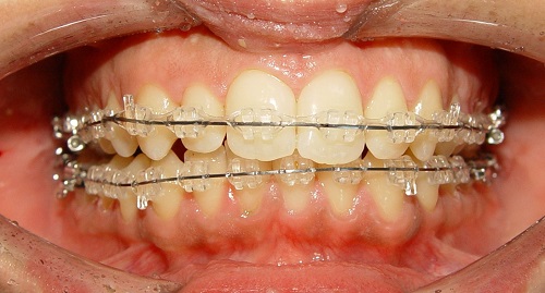 Niềng răng mắc cài sứ có đau không cho răng bị hô? 2