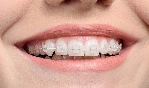 Niềng răng mắc cài sứ dây trong có ưu điểm gì? 2