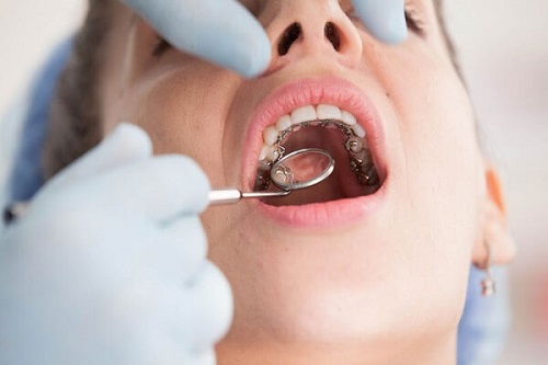 Niềng răng mặt trong có đau không theo quy trình đạt chuẩn? 4