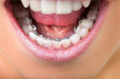 Quá trình thực hiện niềng răng mặt trong mất bao lâu?-4