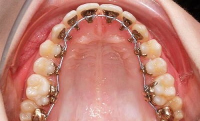 Ưu điểm của niềng răng mặt trong 2 Ưu điểm của niềng răng mặt trong 2