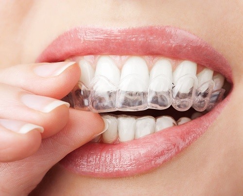 Niềng răng trong suốt có phải nhổ răng không? 1