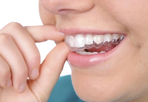 Niềng răng trong suốt mất bao lâu là có kết quả? 1