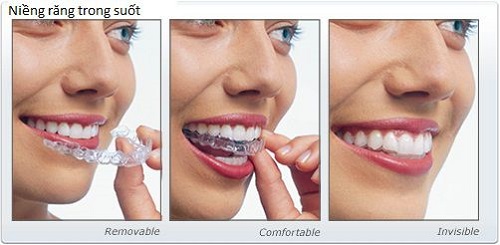 Niềng răng trong suốt mất bao lâu là có kết quả? 2