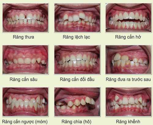 Niềng răng trong suốt mất bao lâu là có kết quả? 3
