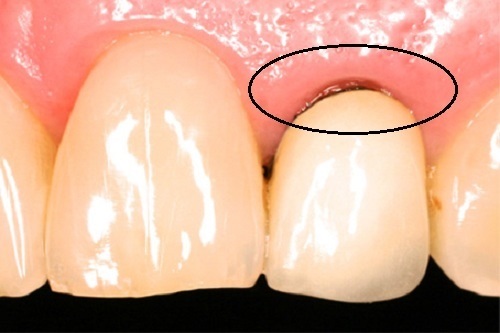 Dấu hiệu răng sứ bị hở nguyên nhân và cách khắc phục-1 Dấu hiệu răng sứ bị hở nguyên nhân và cách khắc phục-1