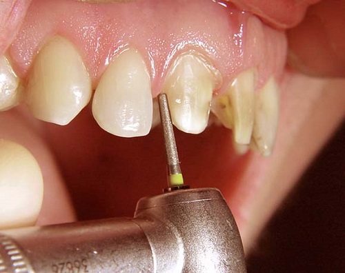 Dấu hiệu răng sứ bị hở nguyên nhân và cách khắc phục-2