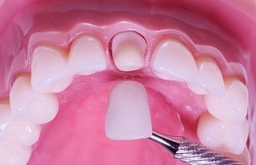 Cảnh báo nguyên nhân khiến răng sứ bị hỏng cần phòng tránh 3