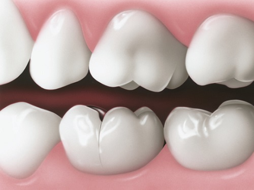 Răng sứ bị nứt phải làm sao để khắc phục?-1