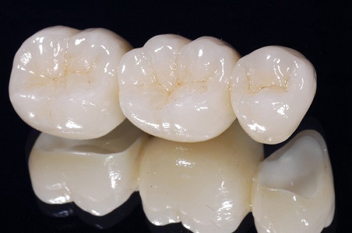 Răng sứ bị nứt phải làm sao để khắc phục?-2