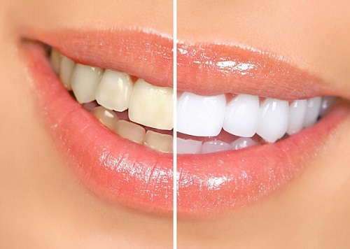 Răng sứ bị vàng cách khắc phục tốt nhất cho bạn 2