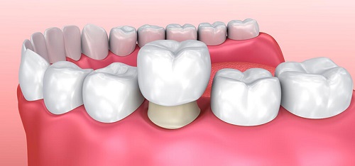 Răng sứ bị vàng cách khắc phục tốt nhất cho bạn 3