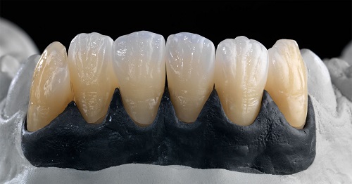 Răng sứ ceramill và những điều cần biết-1