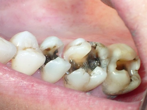 Răng sứ có bị sâu không? Cần làm gì để bảo vệ răng sứ? 1