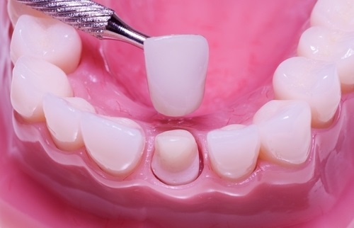 Răng sứ có tháo ra được không? Làm gì khi răng bị vỡ? 1