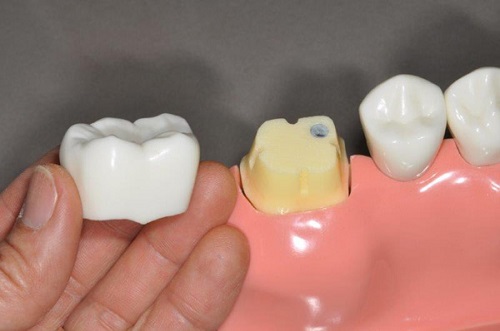 Răng sứ có tháo ra được không? Làm gì khi răng bị vỡ? 2