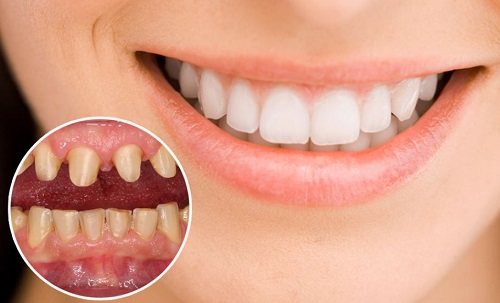 Cách khắc phục răng sứ gây hôi miệng bạn phải biết 1