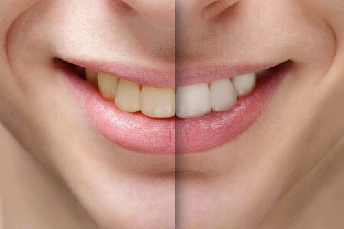 Tẩy trắng răng bằng dầu dừa có hiệu quả cao không? 1