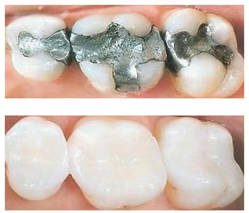 Răng sứ vỡ có hàn được không? Cách khôi phục tốt nhất 2 Răng sứ vỡ có hàn được không? Cách khôi phục tốt nhất 2