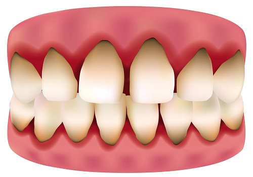 Trồng răng sứ bị đen chân răng - Cách khắc phục nhanh chóng-1