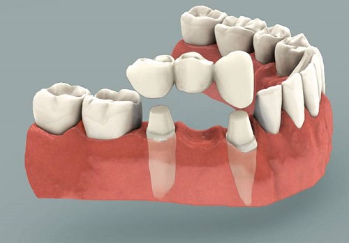 Trồng răng sứ có ảnh hưởng gì không? Chuyên gia giải đáp-1