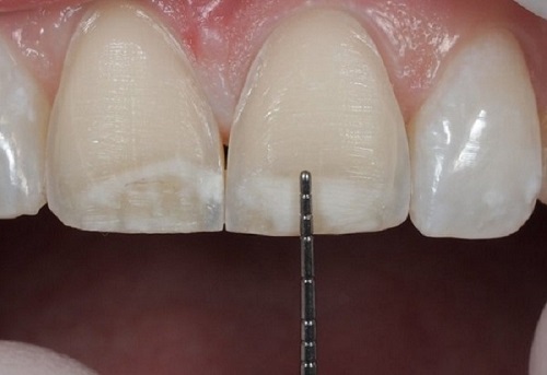 Trồng răng sứ có ảnh hưởng gì không? Chuyên gia giải đáp-2