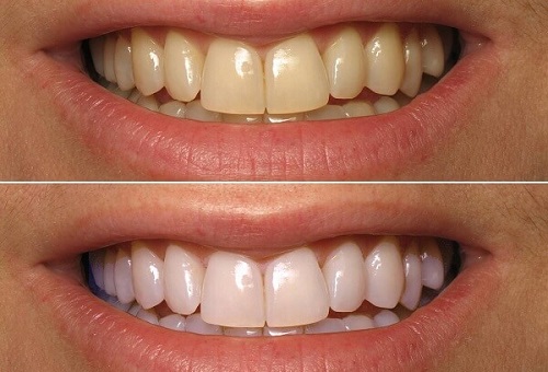 Bột tẩy trắng răng eucryl có tốt không? Thông tin bạn cần nắm 3