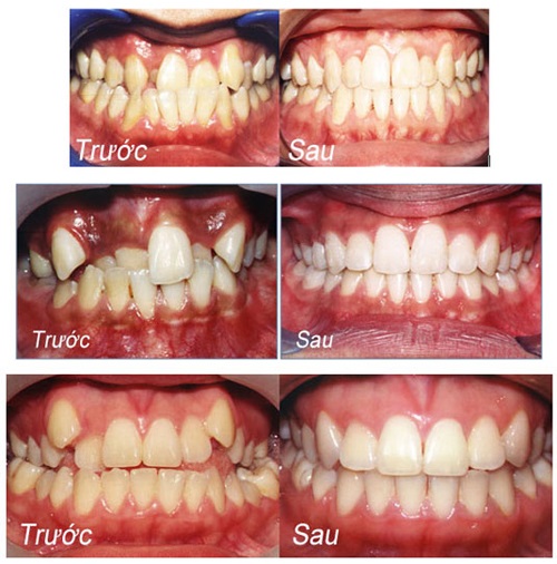 Có nên trồng răng sứ titan không? Ưu và nhược điểm-2 Có nên trồng răng sứ titan không? Ưu và nhược điểm-2