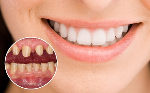 Làm răng sứ - Những lợi ích tuyệt vời mà bạn chưa biết 1
