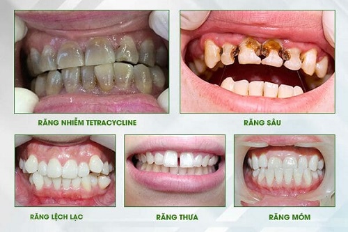 Làm răng sứ - Những lợi ích tuyệt vời mà bạn chưa biết 2 Làm răng sứ - Những lợi ích tuyệt vời mà bạn chưa biết 2