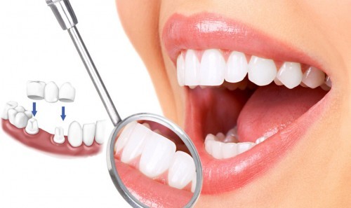 Làm răng sứ - Những lợi ích tuyệt vời mà bạn chưa biết 3